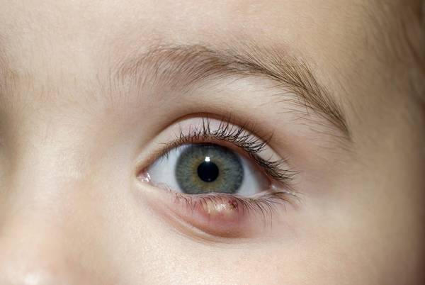 Pourquoi Ne Faut Il Pas Percer Un Orgelet L Apothicaire